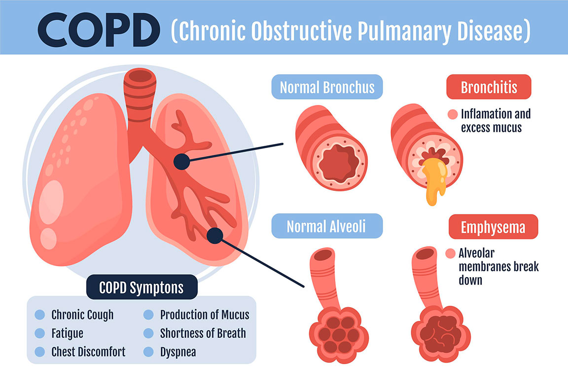 Χρόνια Αποφρακτική Πνευμονοπάθεια (ΧΑΠ - COPD)